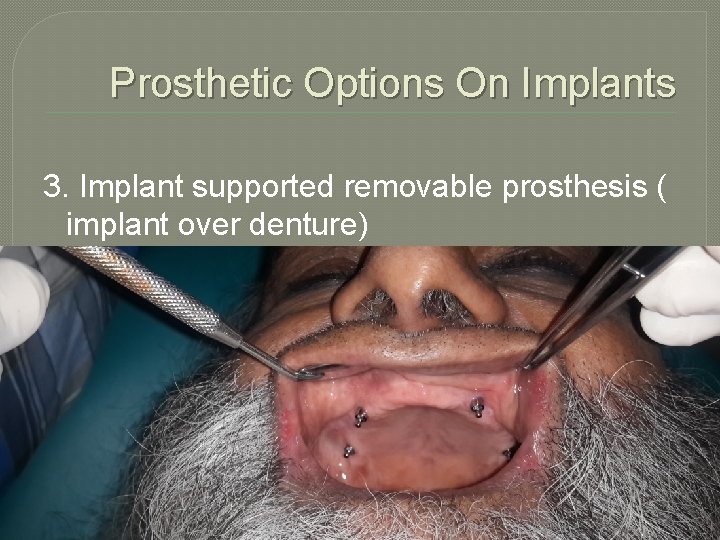 Prosthetic Options On Implants 3. Implant supported removable prosthesis ( implant over denture) 