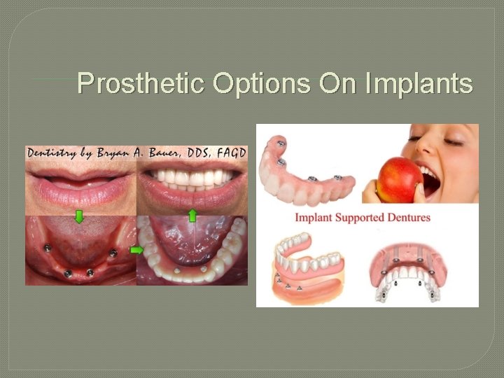 Prosthetic Options On Implants 