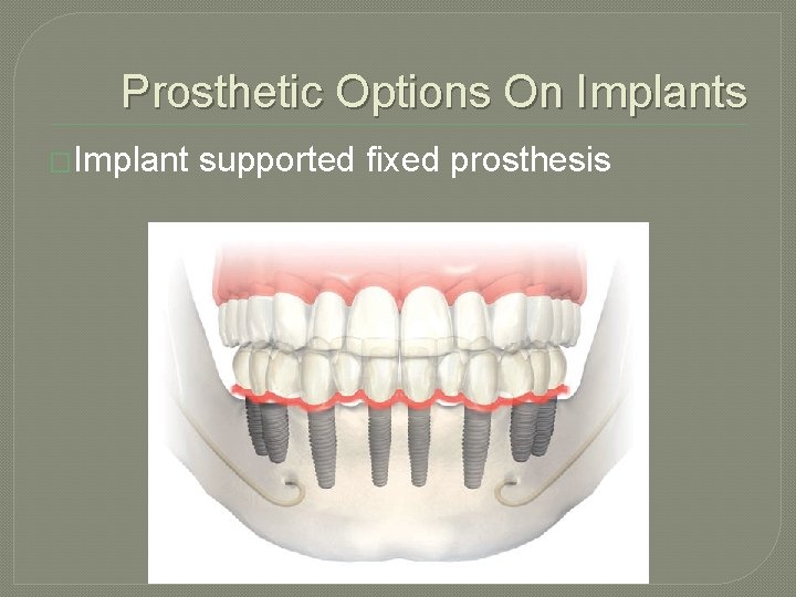 Prosthetic Options On Implants �Implant supported fixed prosthesis 