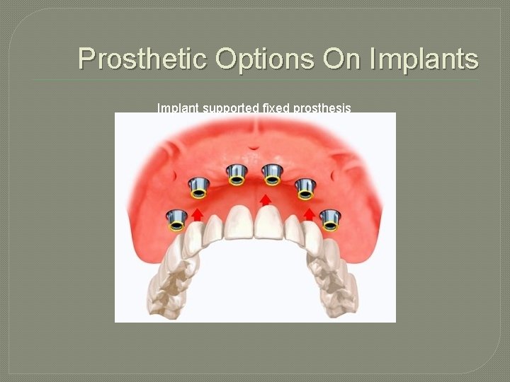 Prosthetic Options On Implants Implant supported fixed prosthesis 