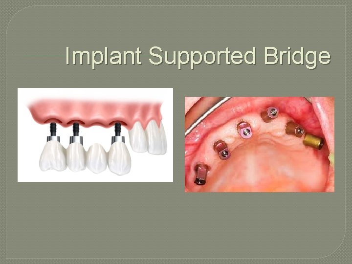 Implant Supported Bridge 