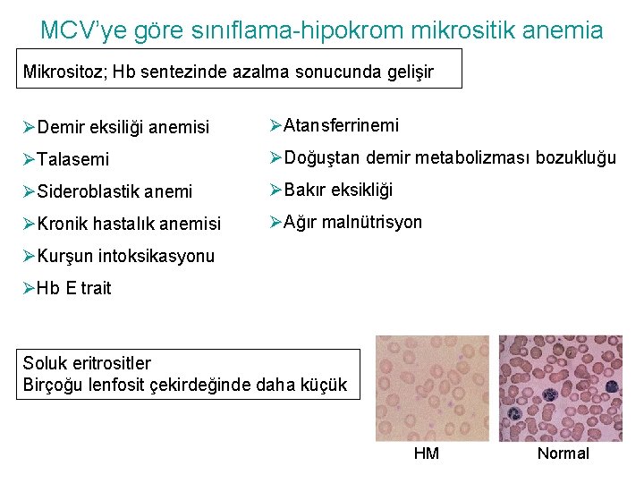 MCV’ye göre sınıflama-hipokrom mikrositik anemia Mikrositoz; Hb sentezinde azalma sonucunda gelişir ØDemir eksiliği anemisi