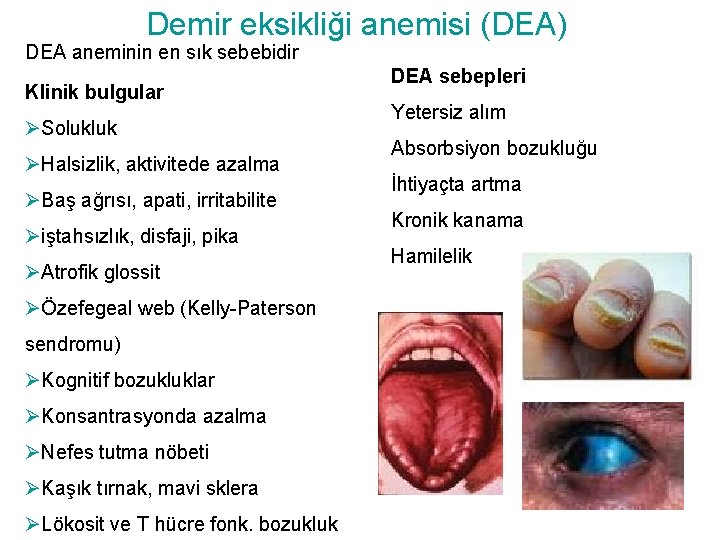 Demir eksikliği anemisi (DEA) DEA aneminin en sık sebebidir Klinik bulgular ØSolukluk ØHalsizlik, aktivitede