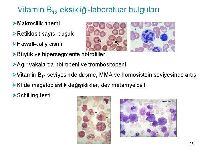 Vitamin B 12 eksikliği-laboratuar bulguları ØMakrositik anemi ØRetiklosit sayısı düşük ØHowell-Jolly cismi ØBüyük ve