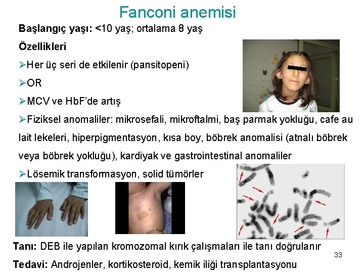 Fanconi anemisi Başlangıç yaşı: <10 yaş; ortalama 8 yaş Özellikleri ØHer üç seri de