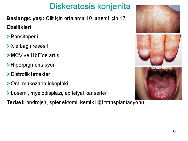 Diskeratosis konjenita Başlangıç yaşı: Cilt için ortalama 10, anemi için 17 Özellikleri ØPansitopeni ØX’e