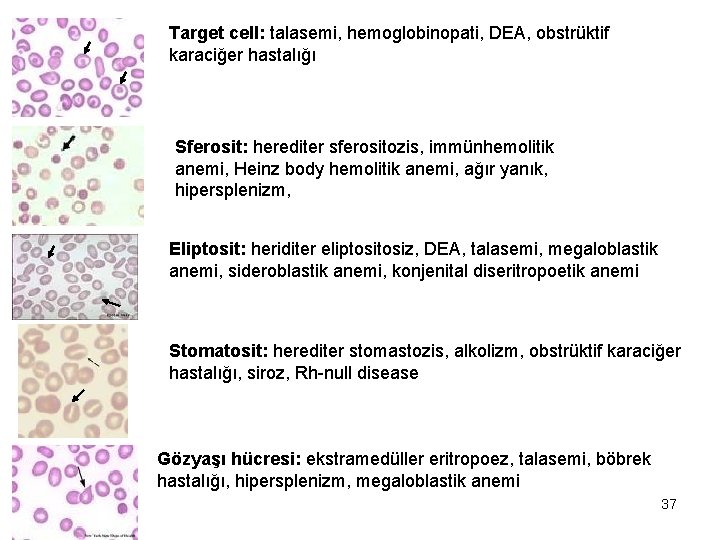 Target cell: talasemi, hemoglobinopati, DEA, obstrüktif karaciğer hastalığı Sferosit: herediter sferositozis, immünhemolitik anemi, Heinz