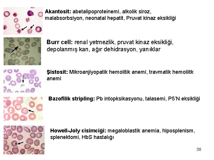 Akantosit: abetalipoproteinemi, alkolik siroz, malabsorbsiyon, neonatal hepatit, Pruvat kinaz eksikliği Burr cell: renal yetmezlik,