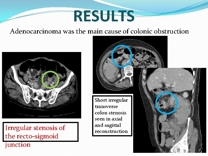 RESULTS Adenocarcinoma was the main cause of colonic obstruction Irregular stenosis of the recto-sigmoid