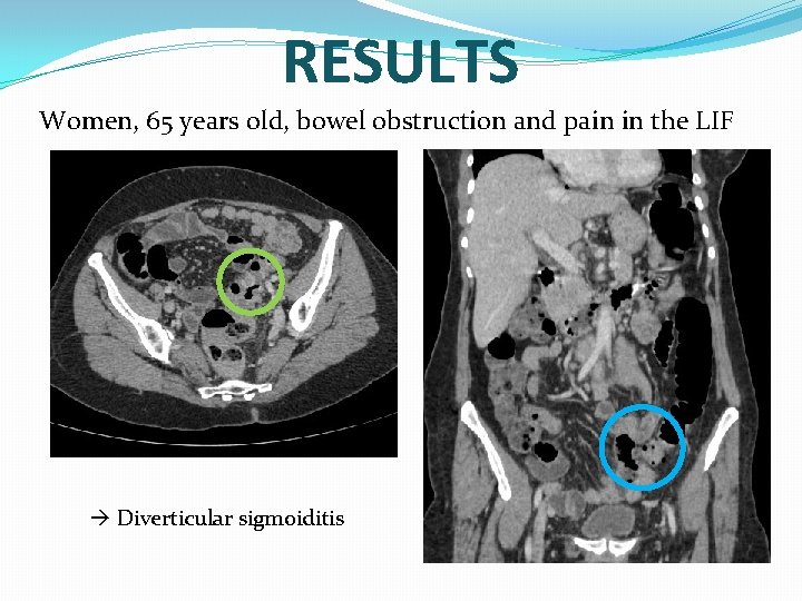 RESULTS Women, 65 years old, bowel obstruction and pain in the LIF Diverticular sigmoiditis