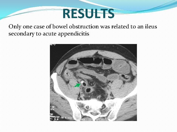 RESULTS Only one case of bowel obstruction was related to an ileus secondary to