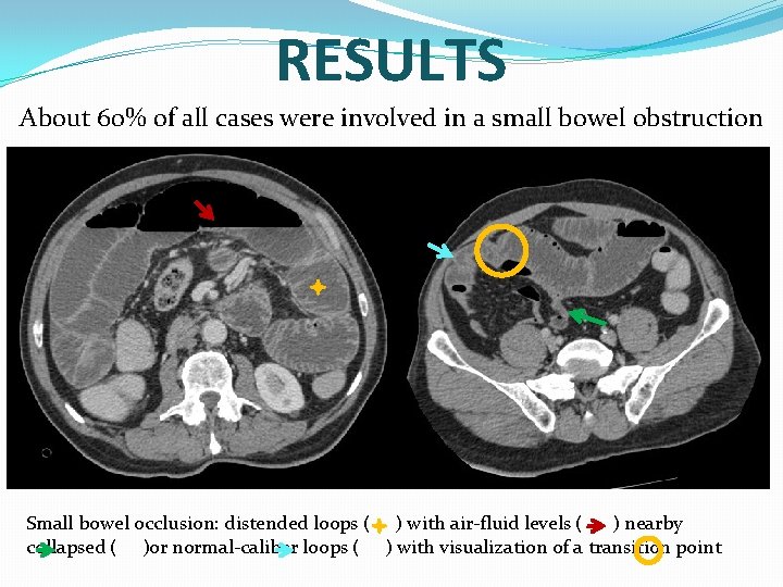 RESULTS About 60% of all cases were involved in a small bowel obstruction Small