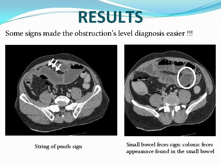 RESULTS Some signs made the obstruction’s level diagnosis easier !!! String of pearls sign