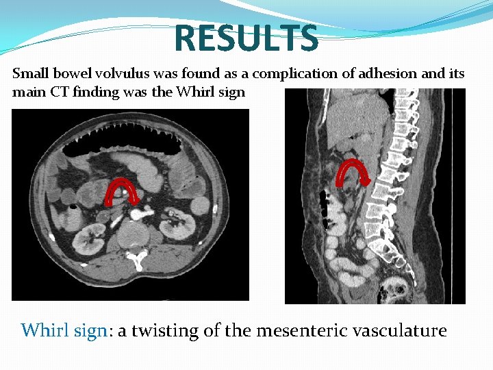 RESULTS Small bowel volvulus was found as a complication of adhesion and its main