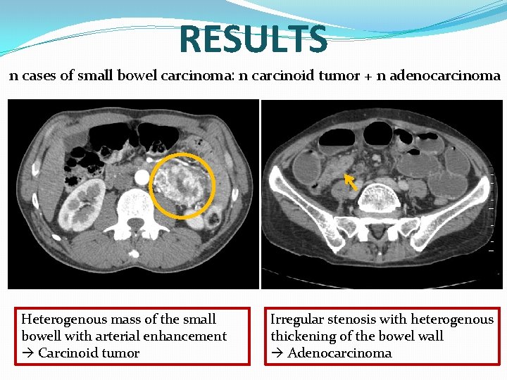 RESULTS n cases of small bowel carcinoma: n carcinoid tumor + n adenocarcinoma Heterogenous