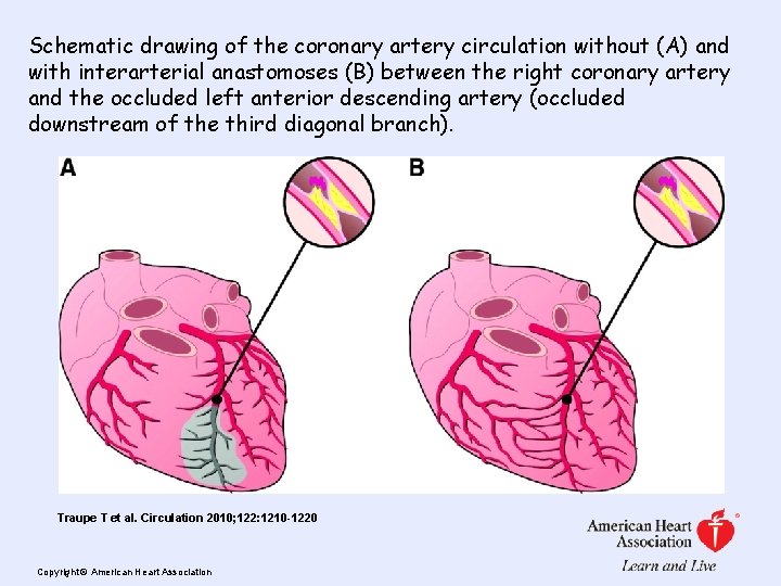 Schematic drawing of the coronary artery circulation without (A) and with interarterial anastomoses (B)