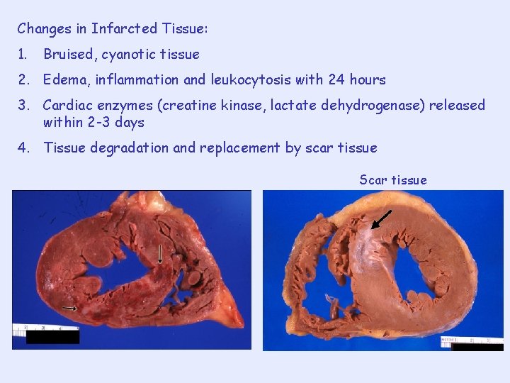 Changes in Infarcted Tissue: 1. Bruised, cyanotic tissue 2. Edema, inflammation and leukocytosis with