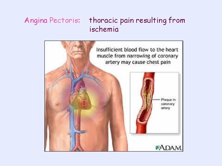 Angina Pectoris: thoracic pain resulting from ischemia 