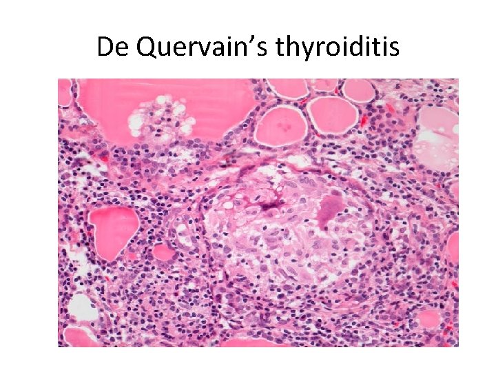 De Quervain’s thyroiditis 