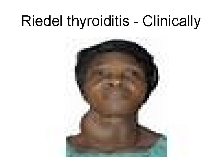 Riedel thyroiditis - Clinically 