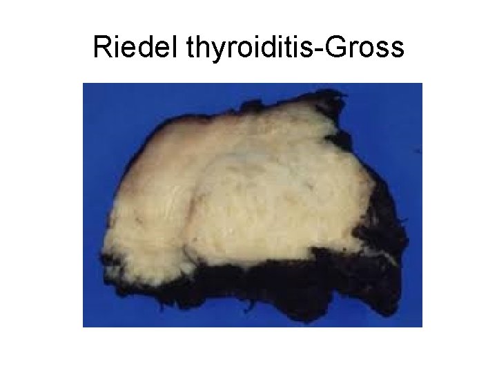 Riedel thyroiditis-Gross 