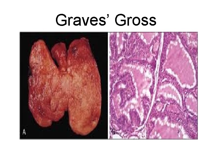 Graves’ Gross 