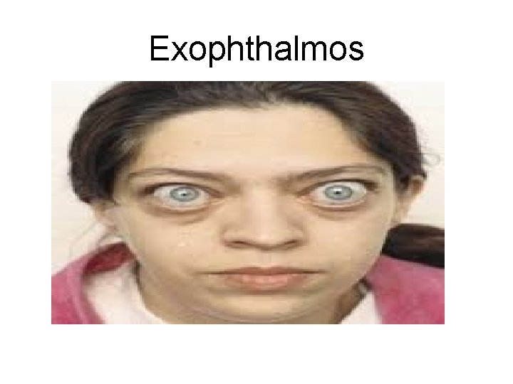 Exophthalmos 