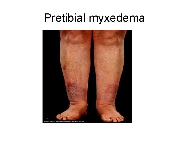 Pretibial myxedema 
