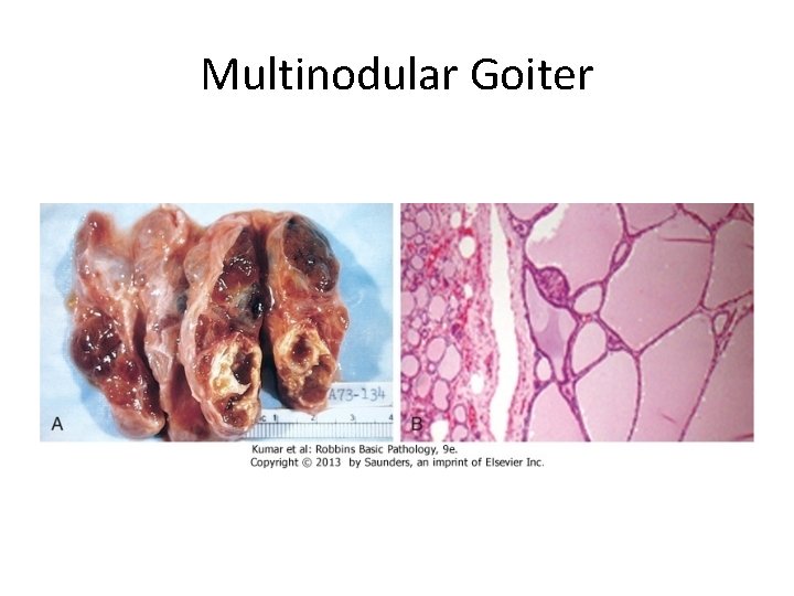 Multinodular Goiter 