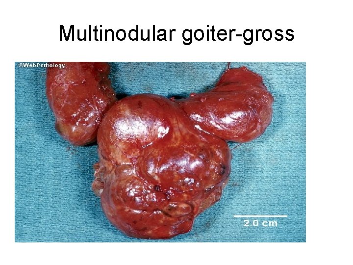 Multinodular goiter-gross 