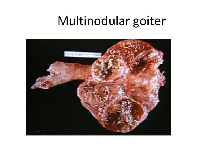 Multinodular goiter 