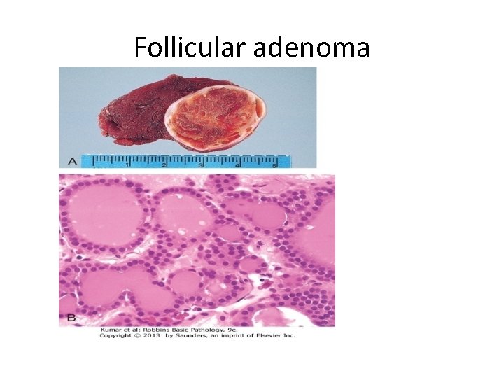 Follicular adenoma 