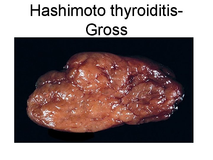 Hashimoto thyroiditis. Gross 