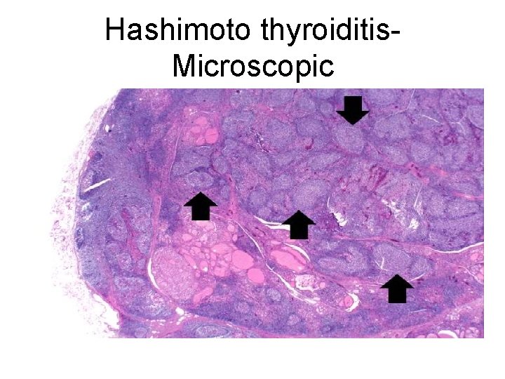Hashimoto thyroiditis. Microscopic 