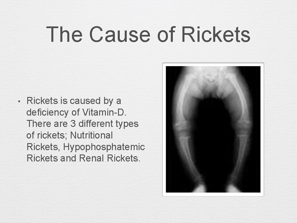 The Cause of Rickets • Rickets is caused by a deficiency of Vitamin-D. There