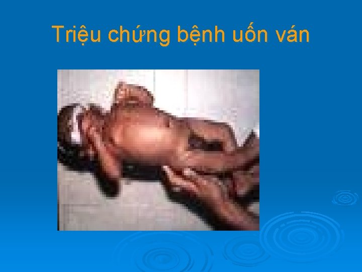 Triệu chứng bệnh uốn ván 