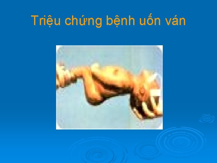 Triệu chứng bệnh uốn ván 