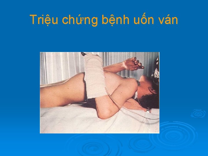 Triệu chứng bệnh uốn ván 