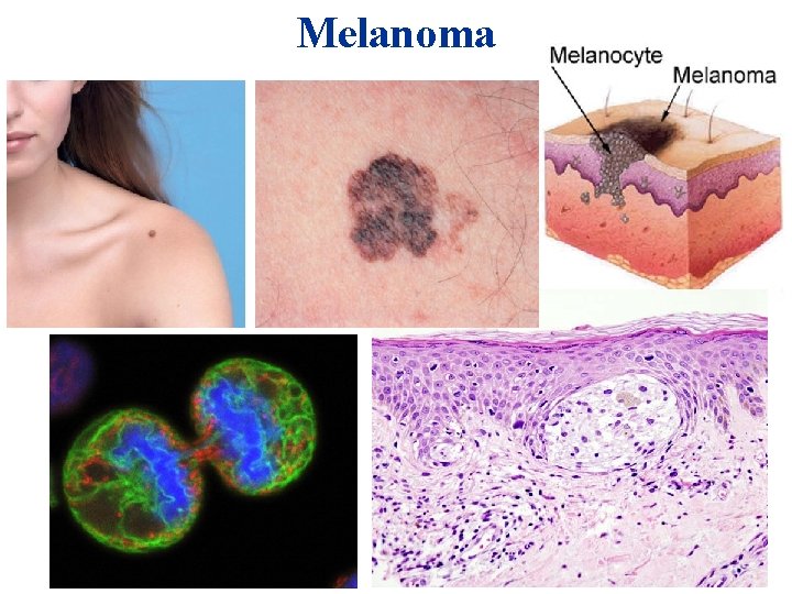 Melanoma Melanoma
