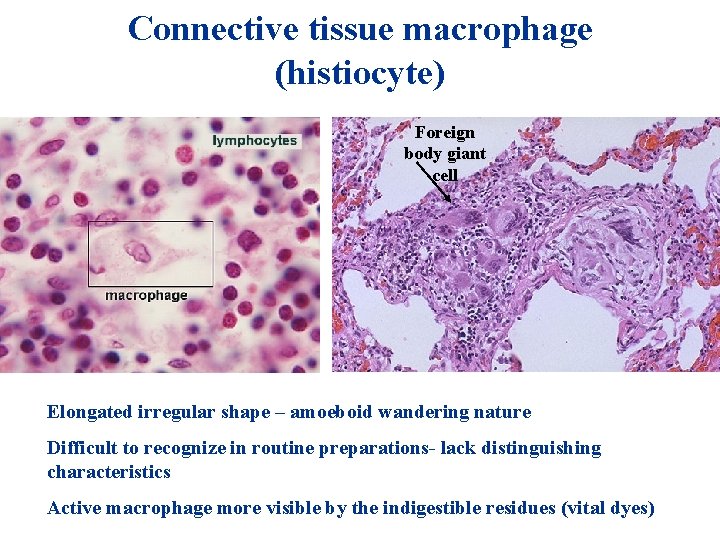 Connective tissue macrophage (histiocyte) + HIO 4 = Foreign body giant cell Elongated irregular Connective tissue macrophage (histiocyte) + HIO 4 = Foreign body giant cell Elongated irregular