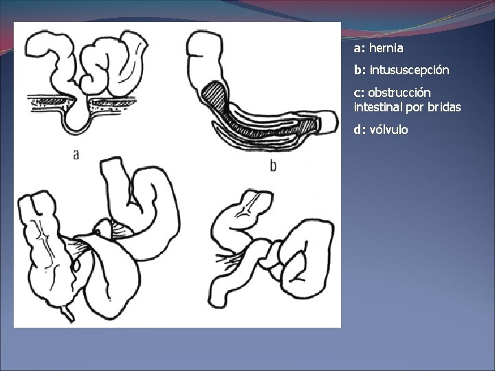 a: hernia b: intususcepción c: obstrucción intestinal por bridas d: vólvulo 