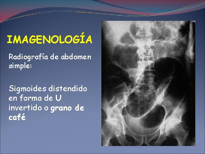 IMAGENOLOGÍA Radiografía de abdomen simple: Sigmoides distendido en forma de U invertido o grano