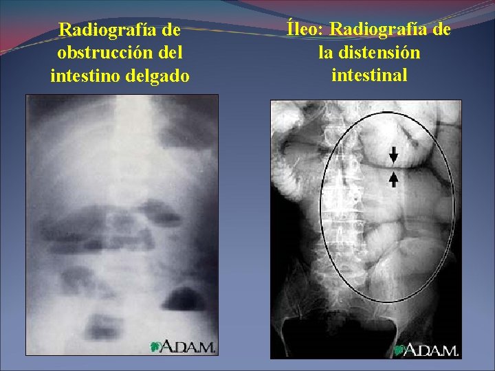 Radiografía de obstrucción del intestino delgado Íleo: Radiografía de la distensión intestinal 