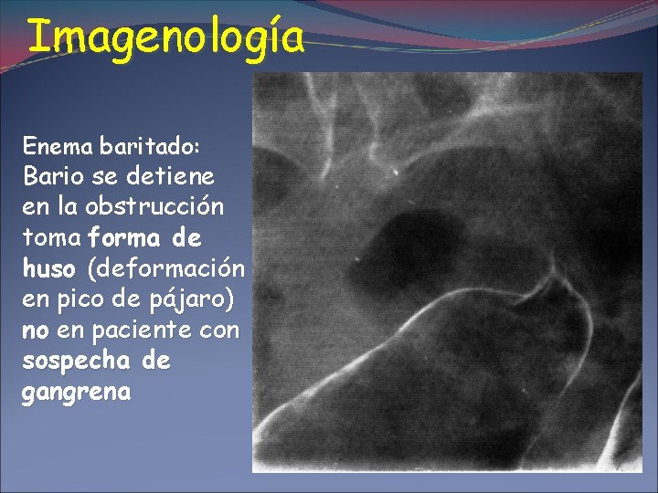 Imagenología Enema baritado: Bario se detiene en la obstrucción toma forma de huso (deformación