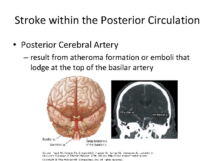 Stroke within the Posterior Circulation • Posterior Cerebral Artery – result from atheroma formation