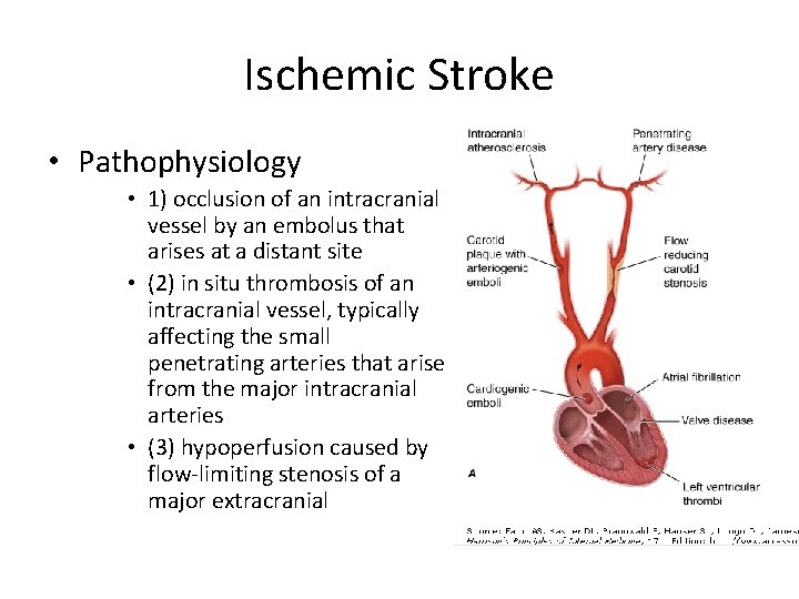 Ischemic Stroke • Pathophysiology • 1) occlusion of an intracranial vessel by an embolus