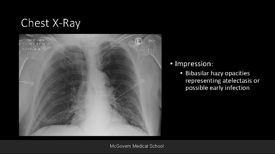 Chest X-Ray • Impression: • Bibasilar hazy opacities representing atelectasis or possible early infection