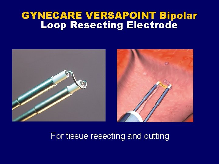 GYNECARE VERSAPOINT Bipolar Loop Resecting Electrode For tissue resecting and cutting 