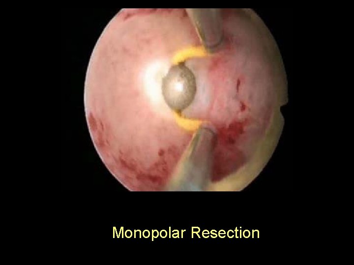 Monopolar Resection 