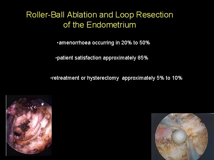 Roller-Ball Ablation and Loop Resection of the Endometrium • amenorrhoea occurring in 20% to